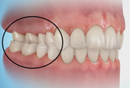 Perfect Smile mal occlusion - Posterior Crossbite